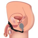 XR Alpha Pro 10X P Bomb Cock and Ball Ring with Anal Plug - Ultimate Pleasure Enhancer - Image 3